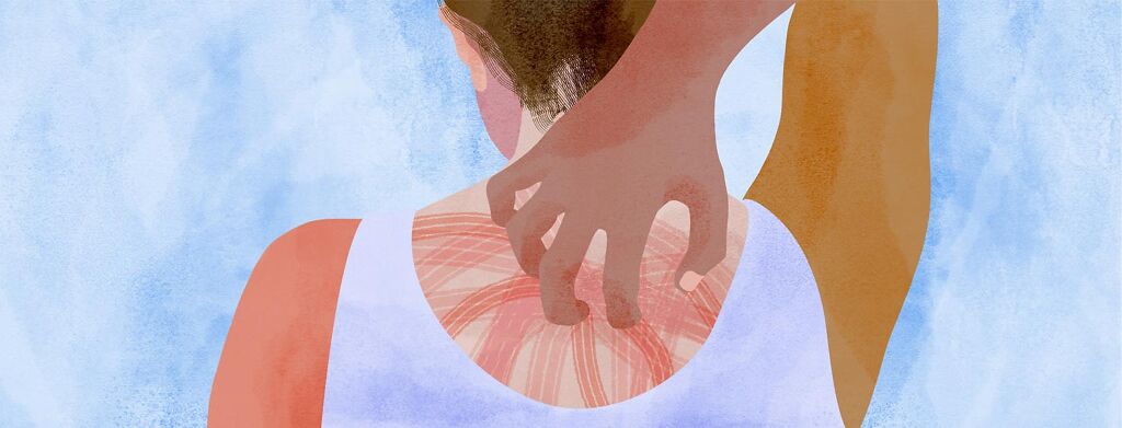 Tips for Treating the "Itch" (Pruritus) With PBC image